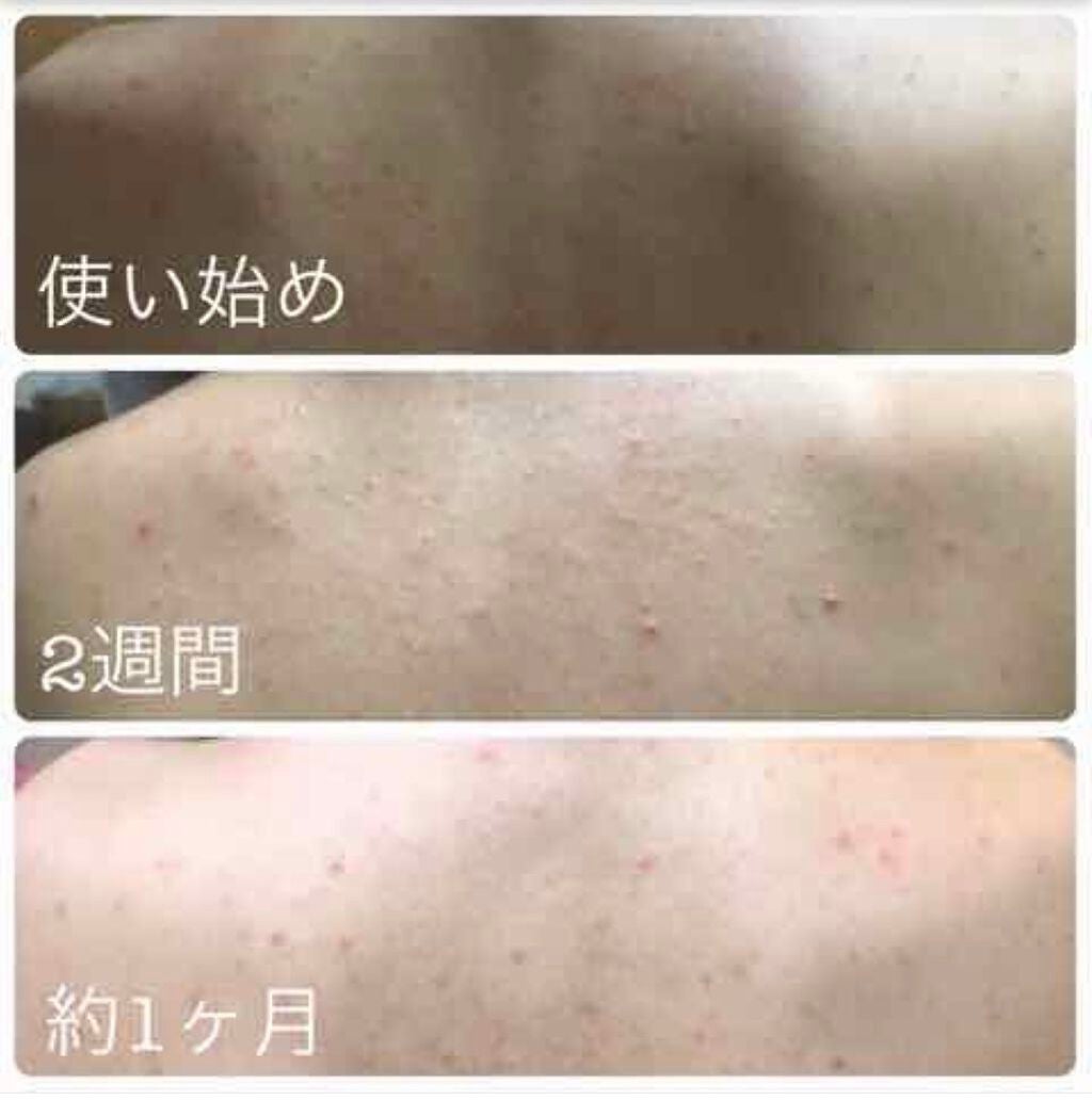 ニキビを防ぐ薬用石鹸 ForBack/ペリカン石鹸/ボディ石鹸を使ったクチコミ(3枚目)