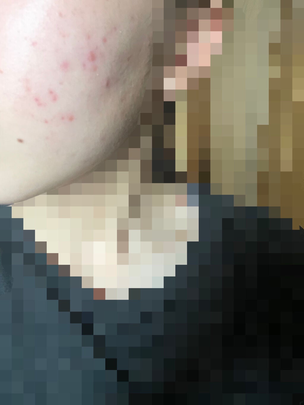 ニキビ治療薬(医薬品)/メンソレータム アクネス/その他を使ったクチコミ(3枚目)