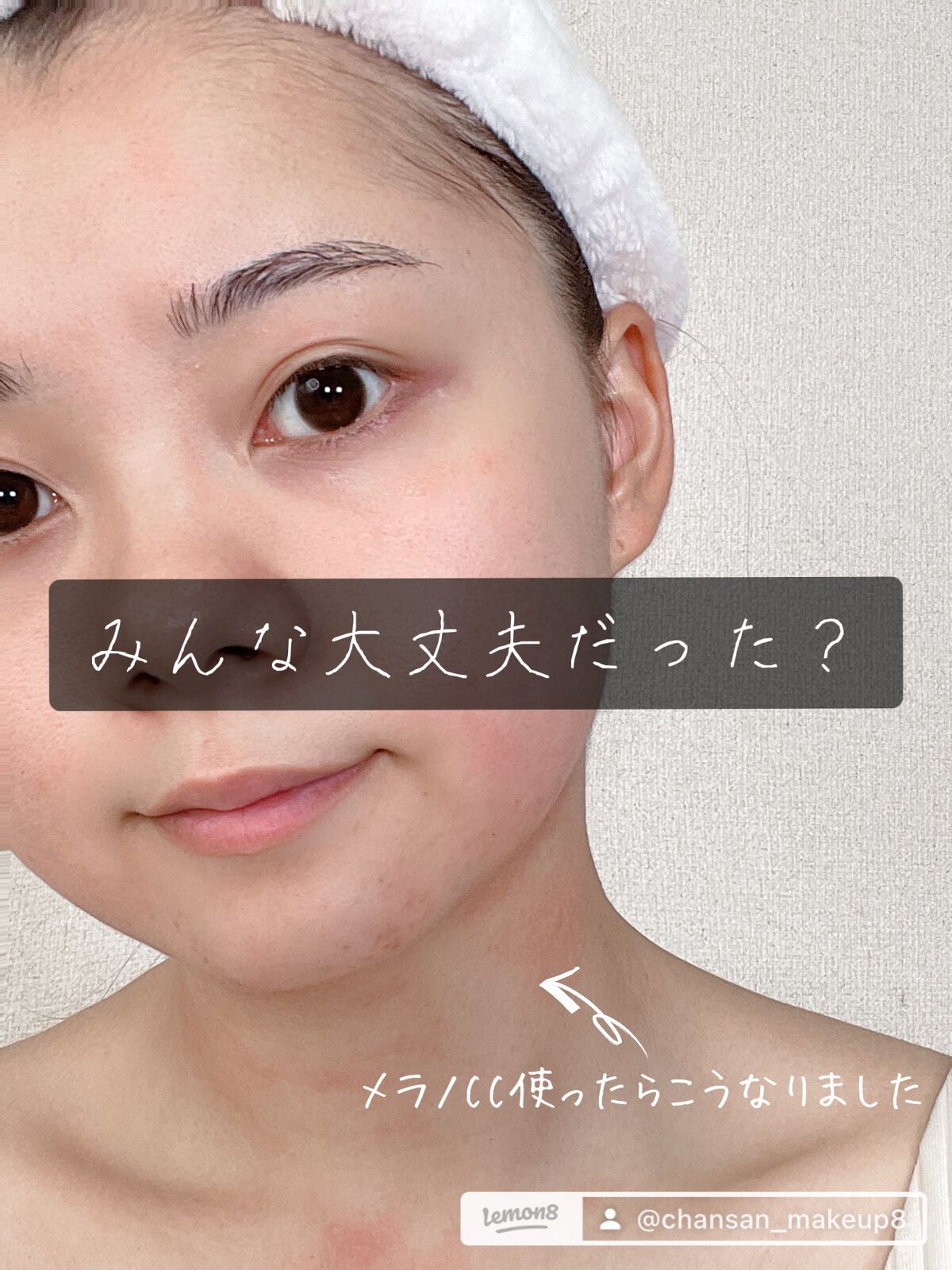 薬用しみ集中対策 プレミアム美容液/メラノCC/美容液を使ったクチコミ（1枚目）