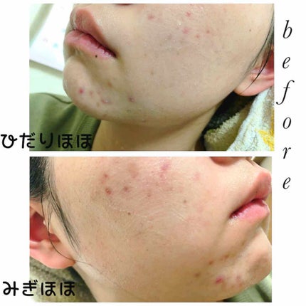 ペアアクネクリームW(医薬品)/ペア/その他を使ったクチコミ(3枚目)