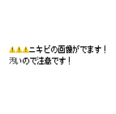 オードムーゲ オードムーゲ 薬用ローション（ふきとり化粧水）のクチコミ「みなさん助けてくださいᵒ̴̶̷᷄௰ᵒ̴̶̷᷅

マスク生活を初めてからニキビが増加しました
前.....」（1枚目）