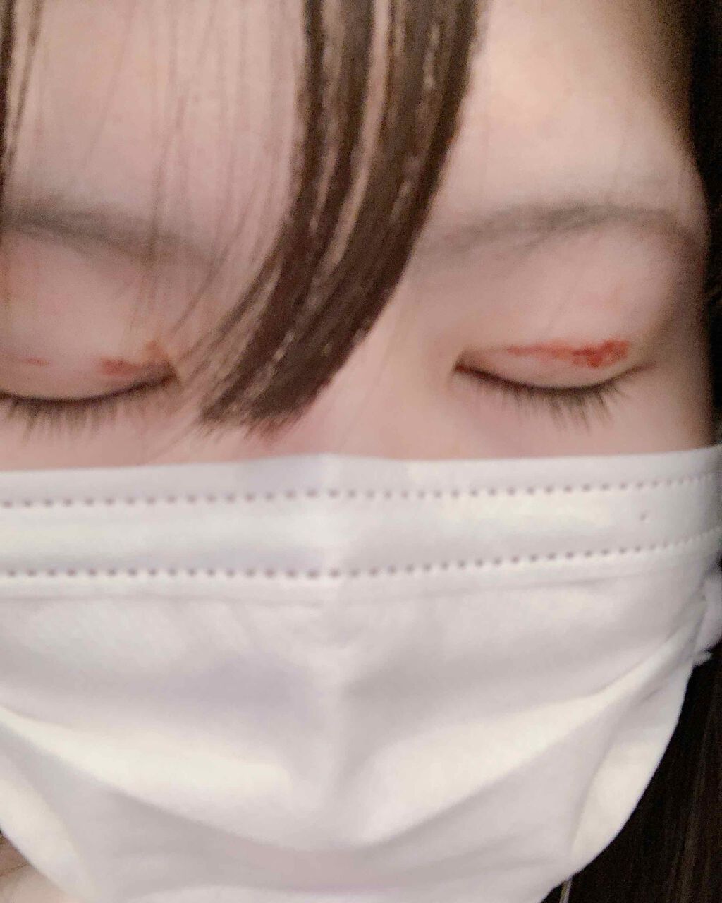 二重整形/その他を使ったクチコミ（2枚目）