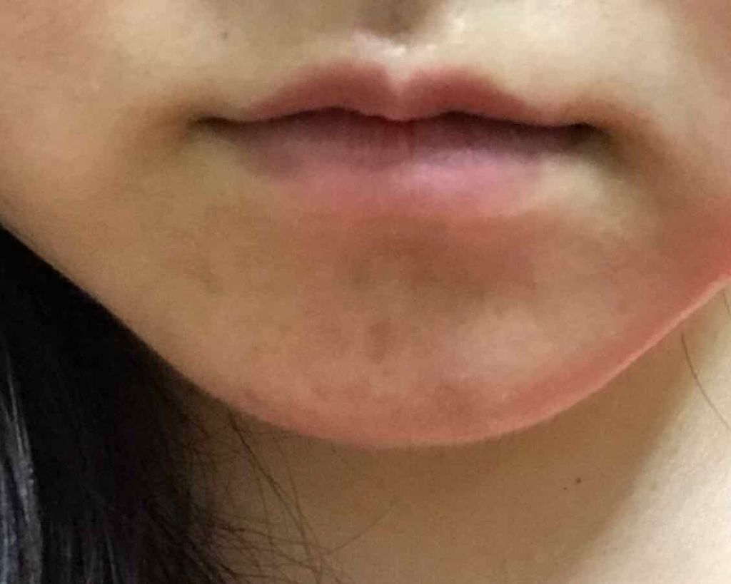 バイオイル/バイオイル/フェイスオイルを使ったクチコミ(3枚目)