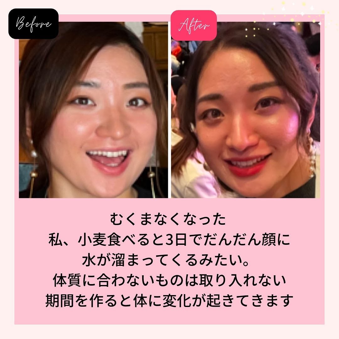 おゆみ|ニキビ・ニキビ跡ケア on LIPS 「@______ohyoume他の投稿はこちらあら【ニキビ治すた..」(4枚目)