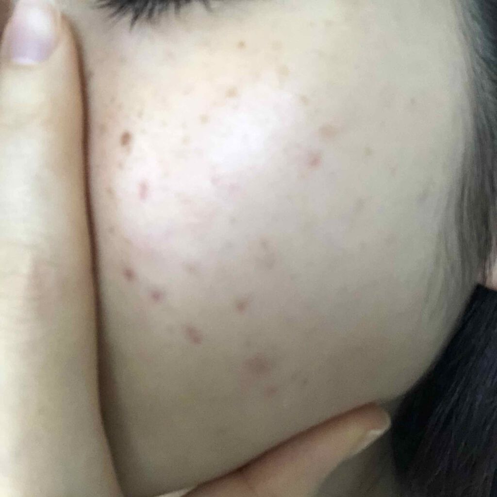 ゆきち on LIPS 「私の汚肌さらします。小さい頃は外で遊ぶの大好きで残ってしまった..」(1枚目)