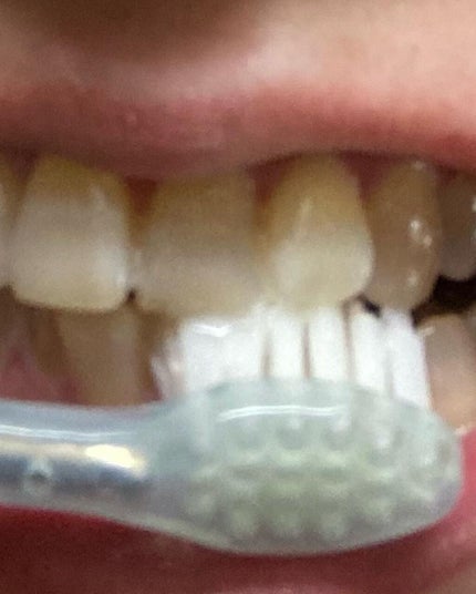 アパガードソフト/アパガード/歯磨き粉を使ったクチコミ(6枚目)