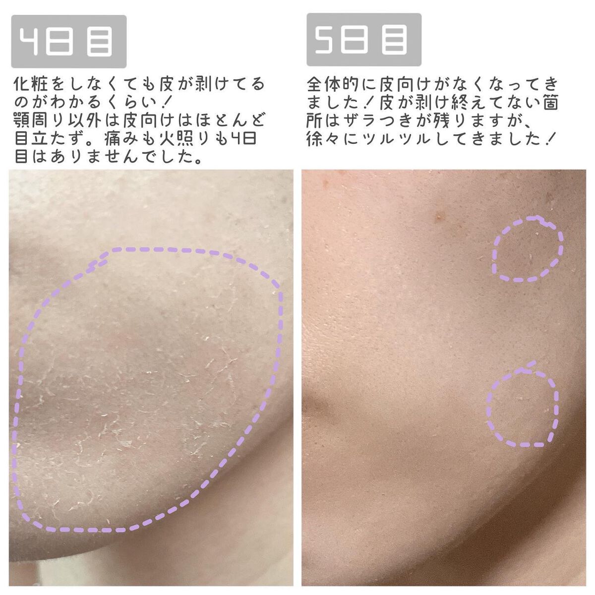 ダーマスキンピーリング/BQCELL/その他キットセットを使ったクチコミ(4枚目)