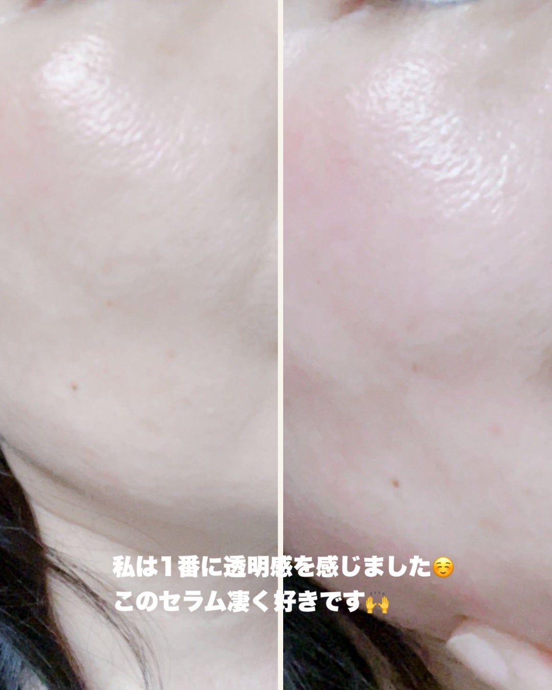 NIACIN 20% セラム/TIRTIR(ティルティル)/美容液を使ったクチコミ(5枚目)