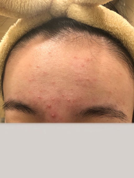 肌荒れ女子 on LIPS 「【閲覧注意⚠️】肌荒れ女子の肌断食日記📖2日目・・・・こんにち..」(5枚目)