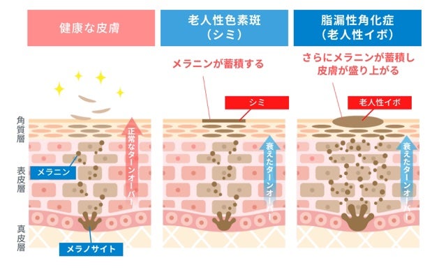 ためしたがり43歳 on LIPS 「イボの変化窒素かけて3日目#窒素#イボ#脂漏性角化症#加齢#老..」(4枚目)