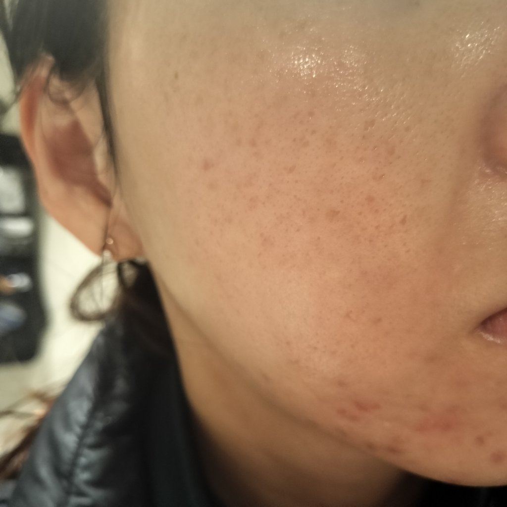 Glucolic Acid 30% Gel Peel/YEOUTH/ピーリングを使ったクチコミ（1枚目）
