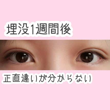 太郎 on LIPS 「お久しぶりです❢太郎と申します❢この度私太郎は念願の埋没をして..」(4枚目)