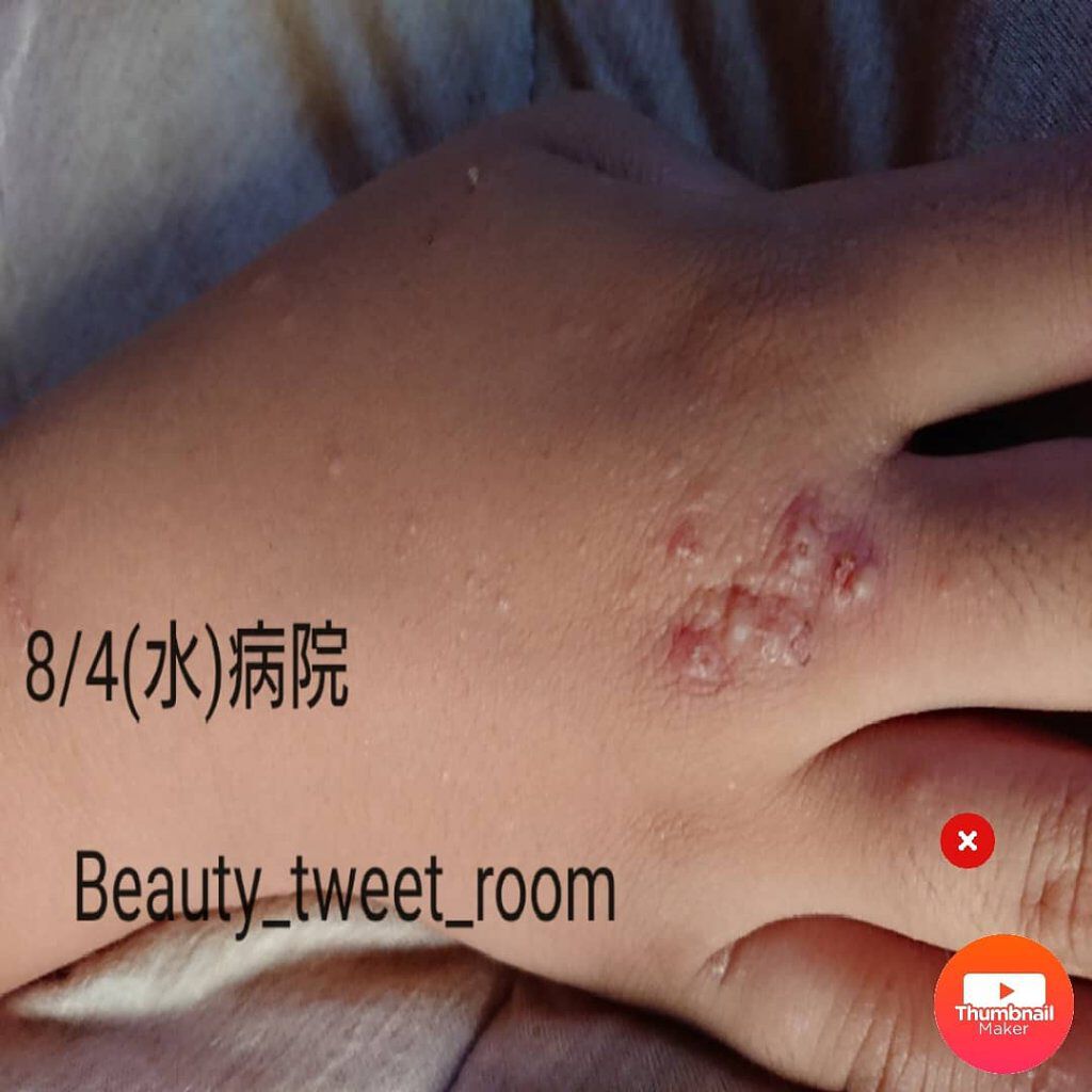 ❥ ❥ ❥ ru-ru-❥ ❥ ❥ on LIPS 「🤔あの右手の発疹が🤔この前投稿した子供の発疹😩💦念の為に病院へ..」(2枚目)