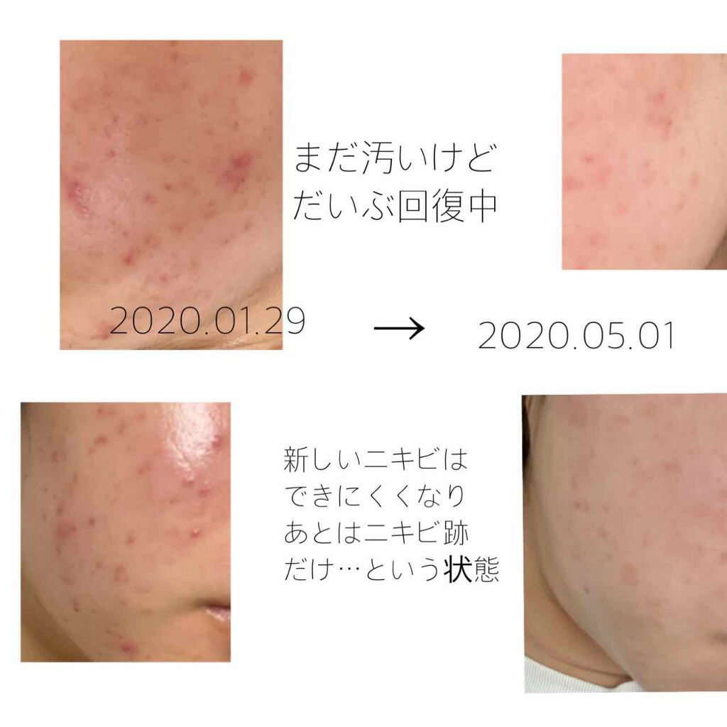 オリジナル ピュアスキンジェリー/ヴァセリン/ボディクリームを使ったクチコミ（2枚目）