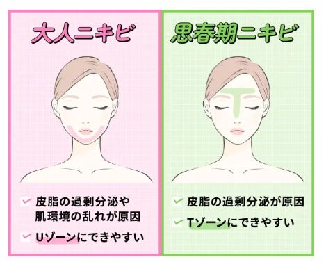 ノンコメドジェニックテスト済み化粧水おすすめ14選!プチプラからデパコスまで紹介の画像
