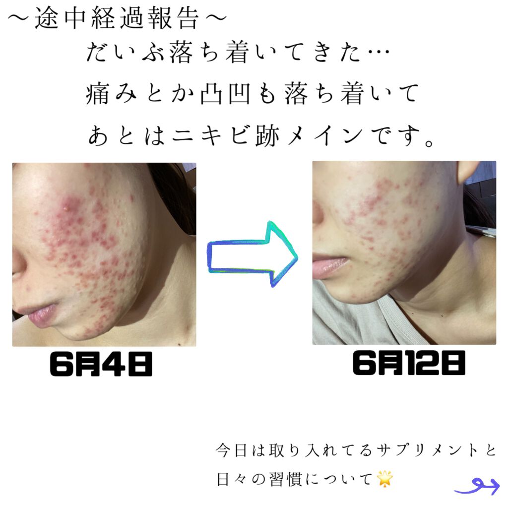 チョコラbbプラス 医薬品 チョコラbbを使った口コミ 6月4日の謎の肌荒れから9日 経過 今 By ほたて 混合肌 代後半 Lips