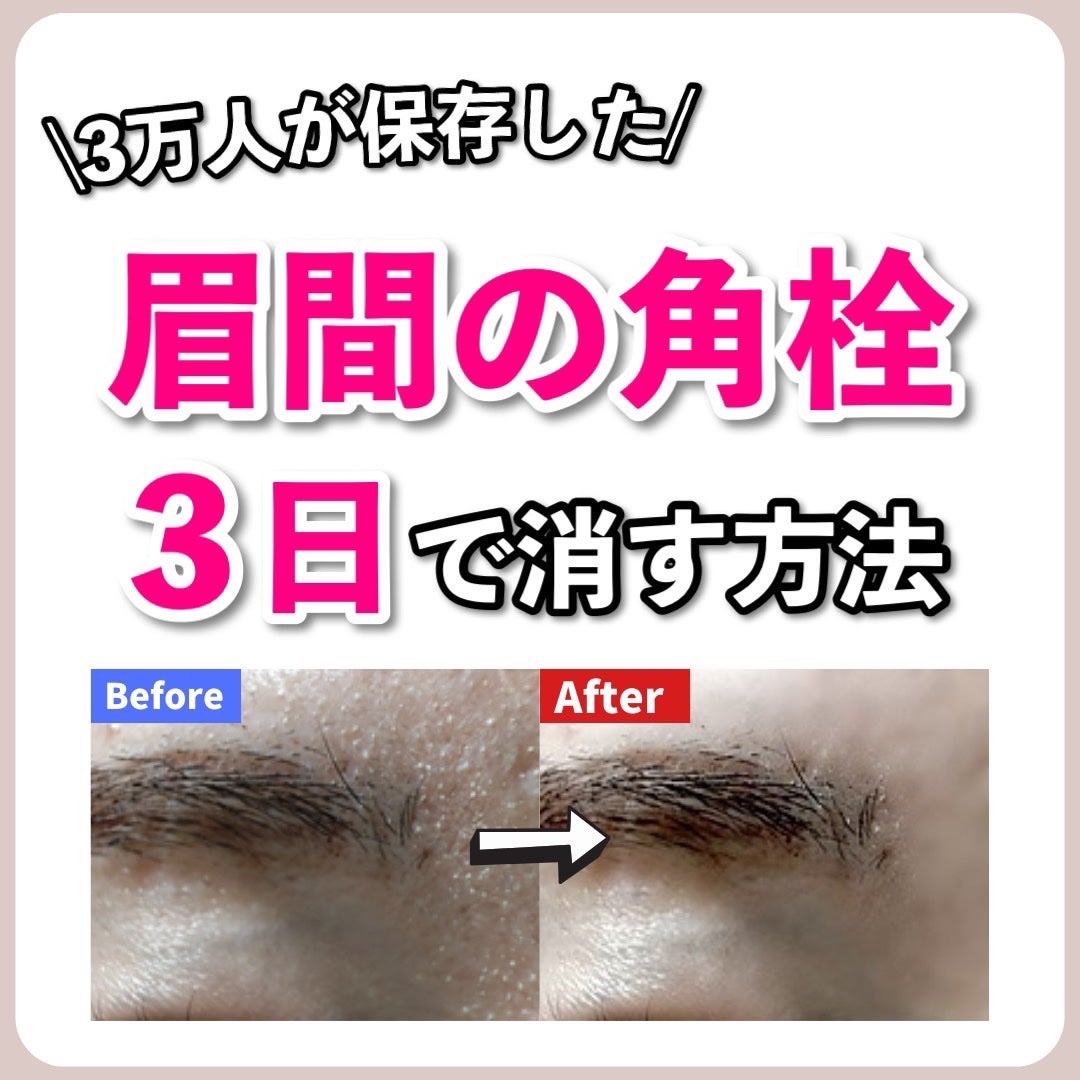 あなたの肌に合ったスキンケア💐コーくん先生 on LIPS 「【9割が知らないと】実はコレすると眉間の角栓がエグい消える😳✌..」(1枚目)