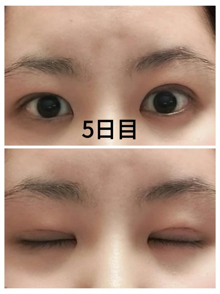 kaira on LIPS 「二重整形しちゃいました🤭今までも何度か二重の投稿をさせてもらっ..」(6枚目)