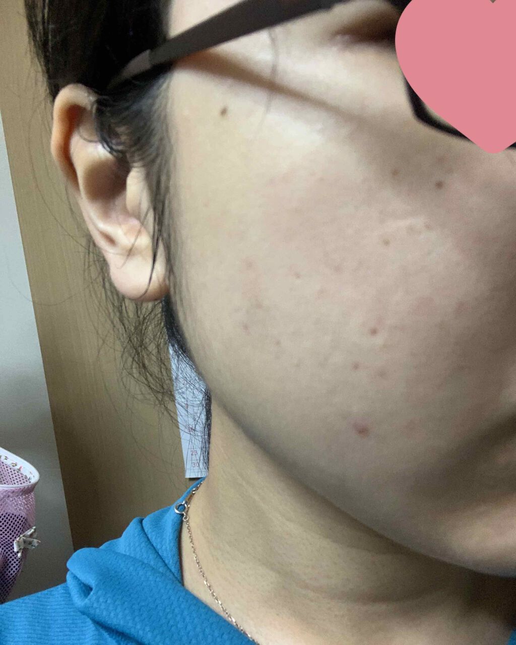 十味敗毒湯 ジュウミハイドクトウ(医薬品)/クラシエ薬品/その他を使ったクチコミ（2枚目）