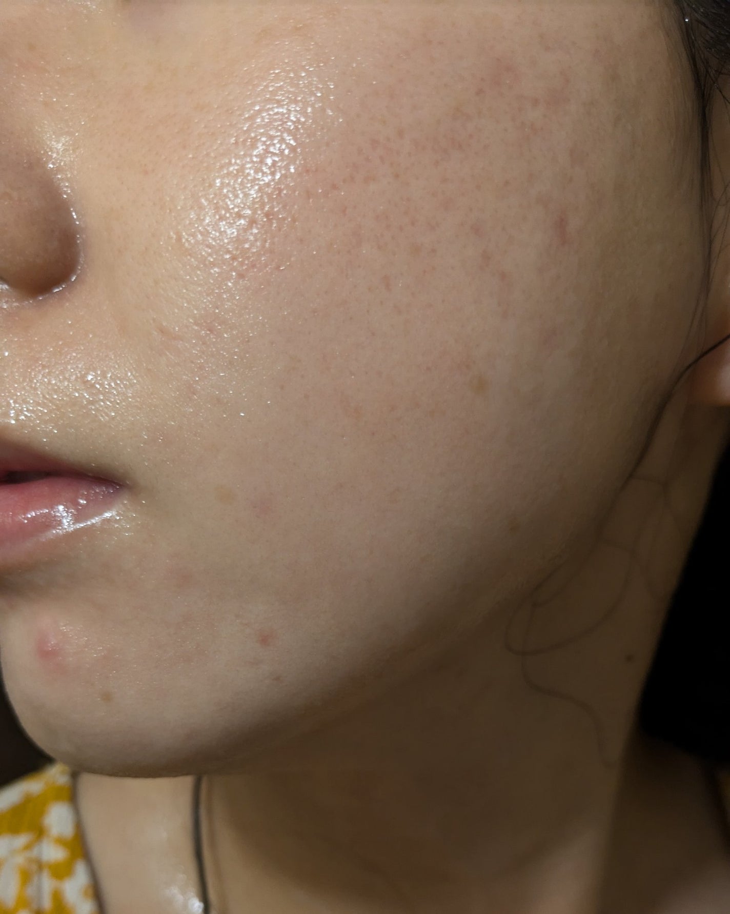 AHA 30% + BHA 2% Peeling Solution/The Ordinary/ピーリングを使ったクチコミ(2枚目)