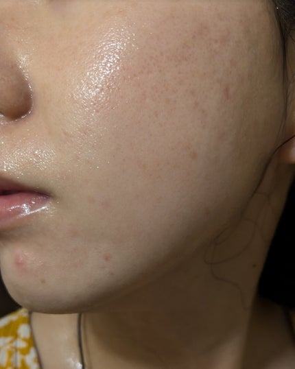 AHA 30% + BHA 2% Peeling Solution/The Ordinary/ピーリングを使ったクチコミ(2枚目)