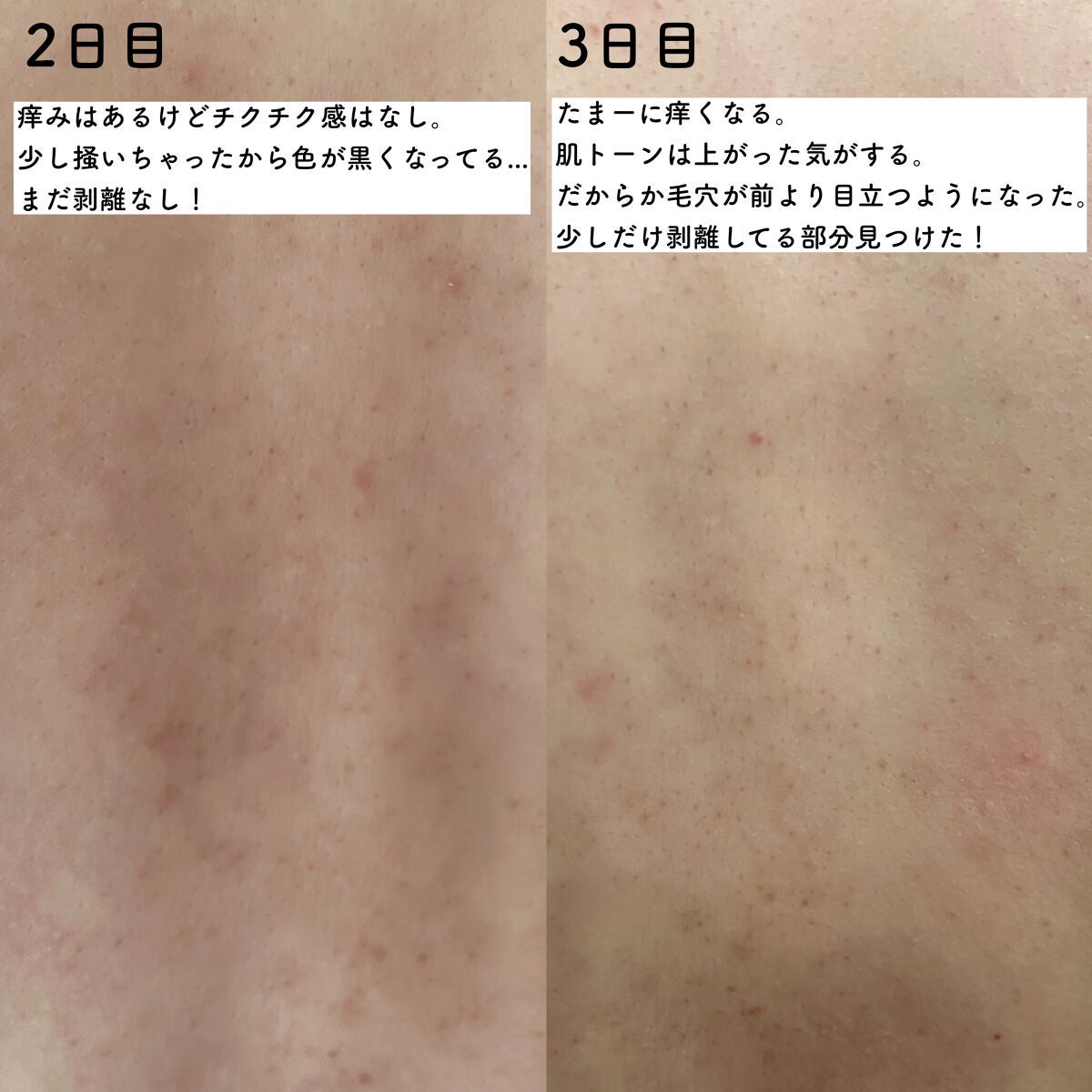 ダーマスキンピーリング/BQCELL/その他キットセットを使ったクチコミ(6枚目)