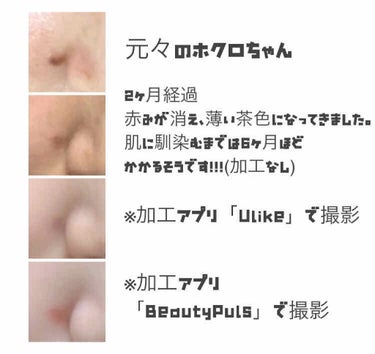 あいママ on LIPS 「あれからあっという間に2ヶ月経ちました！ホクロ除去のきっかけは..」（4枚目）