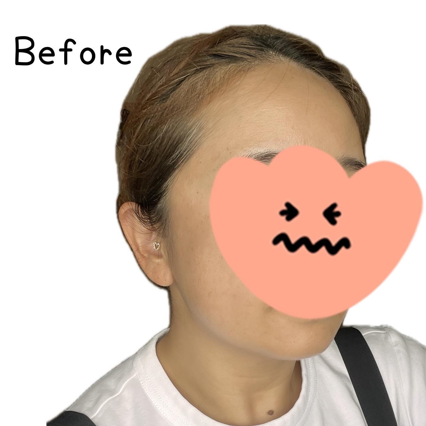 ABC-Gピールウォッシュ/ドクターケイ/泡洗顔を使ったクチコミ（2枚目）