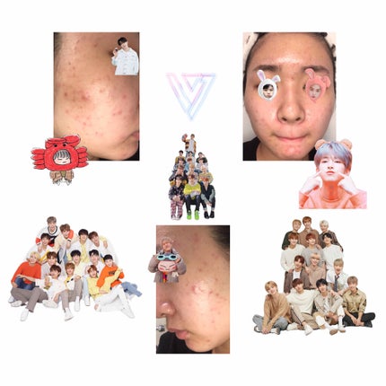 seventeen_scoups on LIPS 「こんにちわ。ニキビだらけの肌投稿して不快に思った方すみません。..」(2枚目)