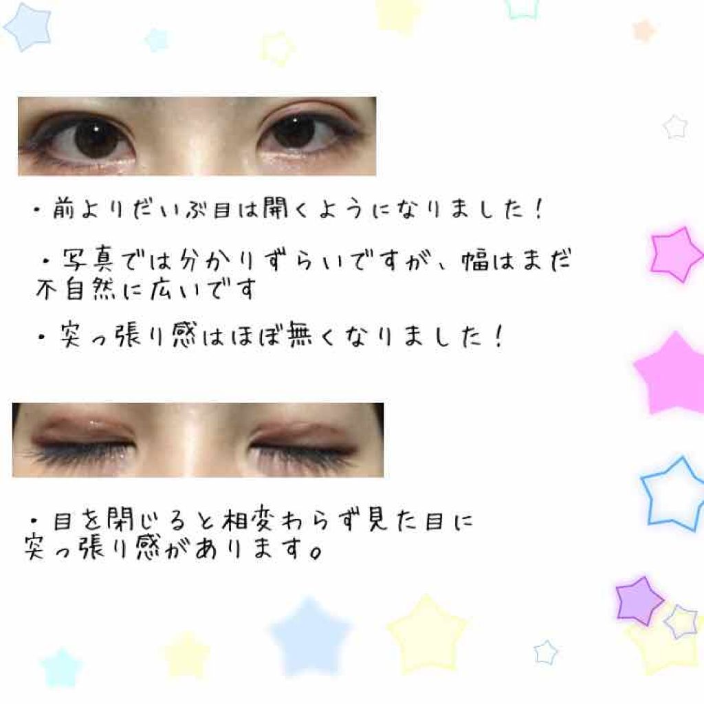 pipi on LIPS 「埋没法と脂肪除去してから11月28日で1ヶ月経ちました。初投稿..」(2枚目)