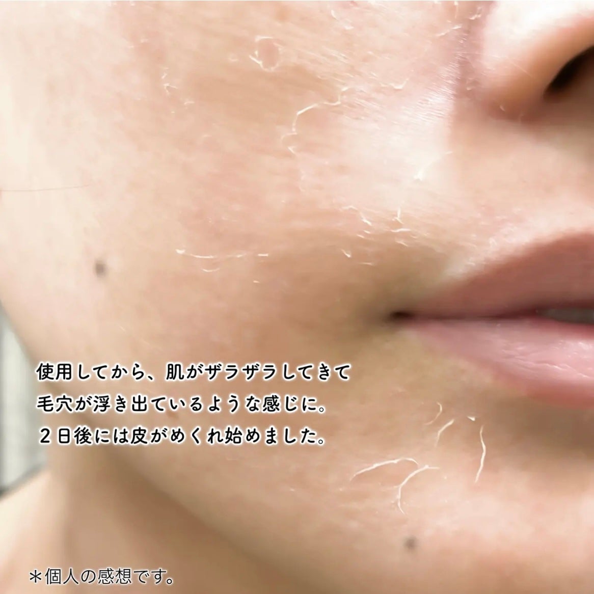 ダーマスキンピーリング/BQCELL/その他キットセットを使ったクチコミ(5枚目)