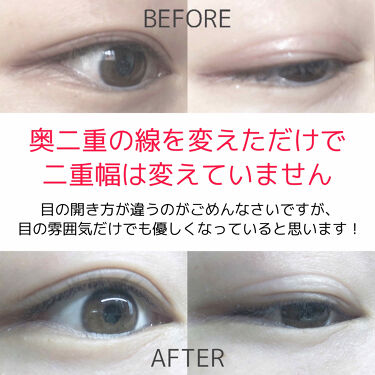 二重になる方法 のび る アイテープ 絆創膏タイプ Daisoの使い方や二重メイク メイクと並行すれば3 By 亜 莉 乾燥肌 10代後半 Lips