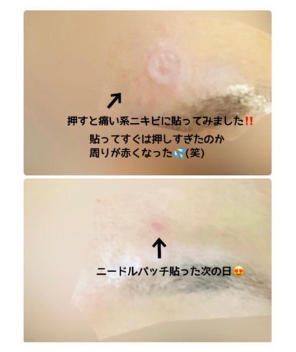 トラブルケアパッチ/大熊製薬/にきびパッチを使ったクチコミ(5枚目)