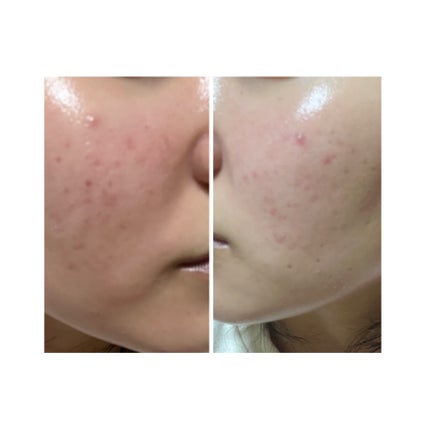 ぽむ on LIPS 「2023.9.13皮膚科に受診 エピデュオとヘパリン処方1枚目..」(5枚目)