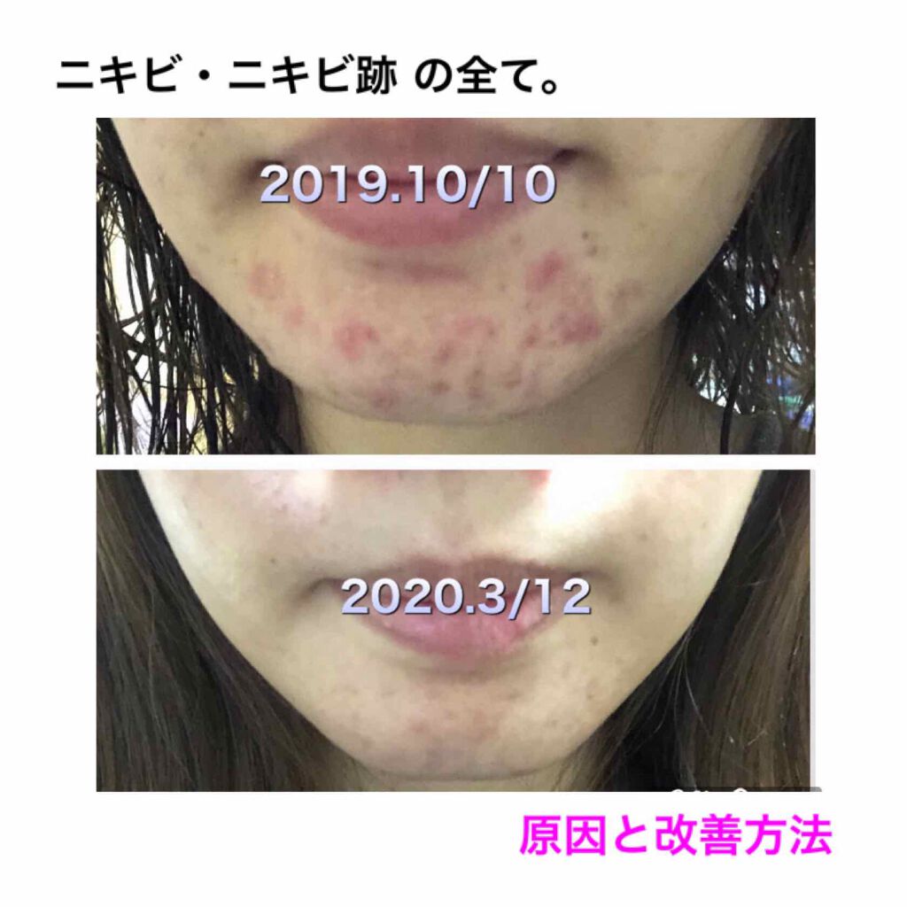 極潤 ヒアルロン液(旧)/肌ラボ/化粧水を使ったクチコミ（1枚目）