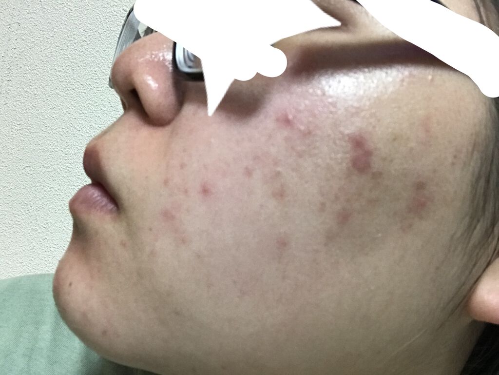 エピデュオゲル/マルホ株式会社/その他を使ったクチコミ（2枚目）