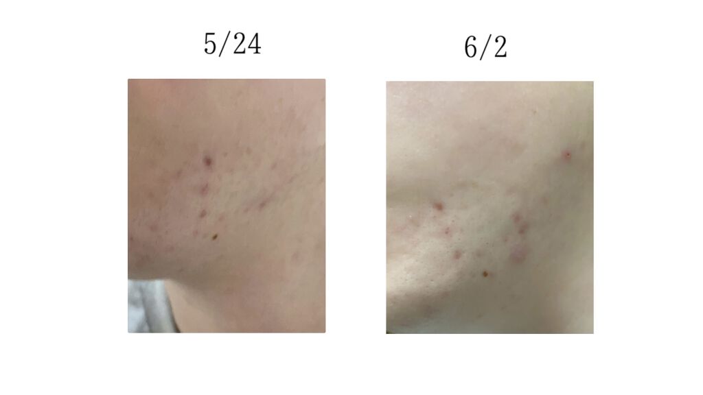 ニキビあとケアジェル/アットノン/その他スキンケアを使ったクチコミ（3枚目）