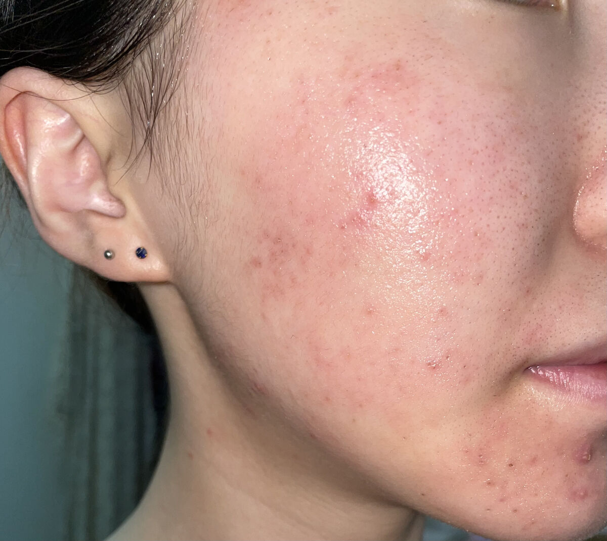 ノブ Ａ アクネソープ/NOV/洗顔石鹸を使ったクチコミ（1枚目）