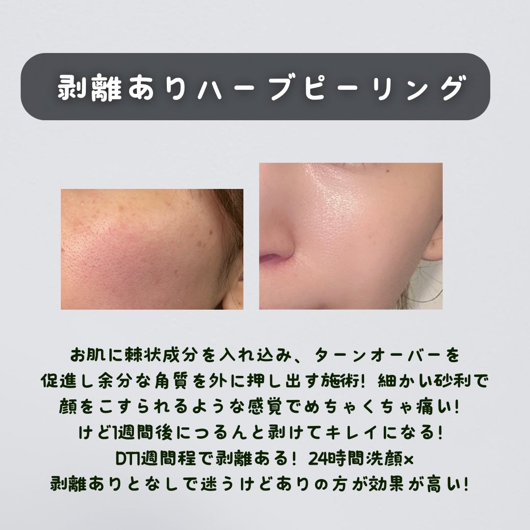 秋瀬ルナ.美容サプリ/韓国コスメ🇰🇷 on LIPS 「最近行った施術(ピーリング系)をまとめてみた!🔹剥離ありハーブ..」(2枚目)