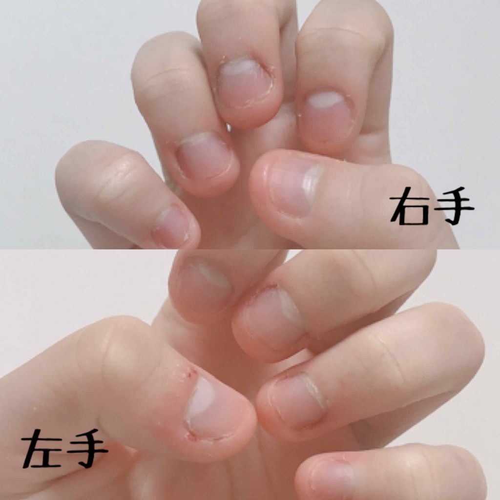 りん on LIPS 「こんにちは!唐突ですが私深爪なんです。。生まれてからずっと噛み..」(2枚目)