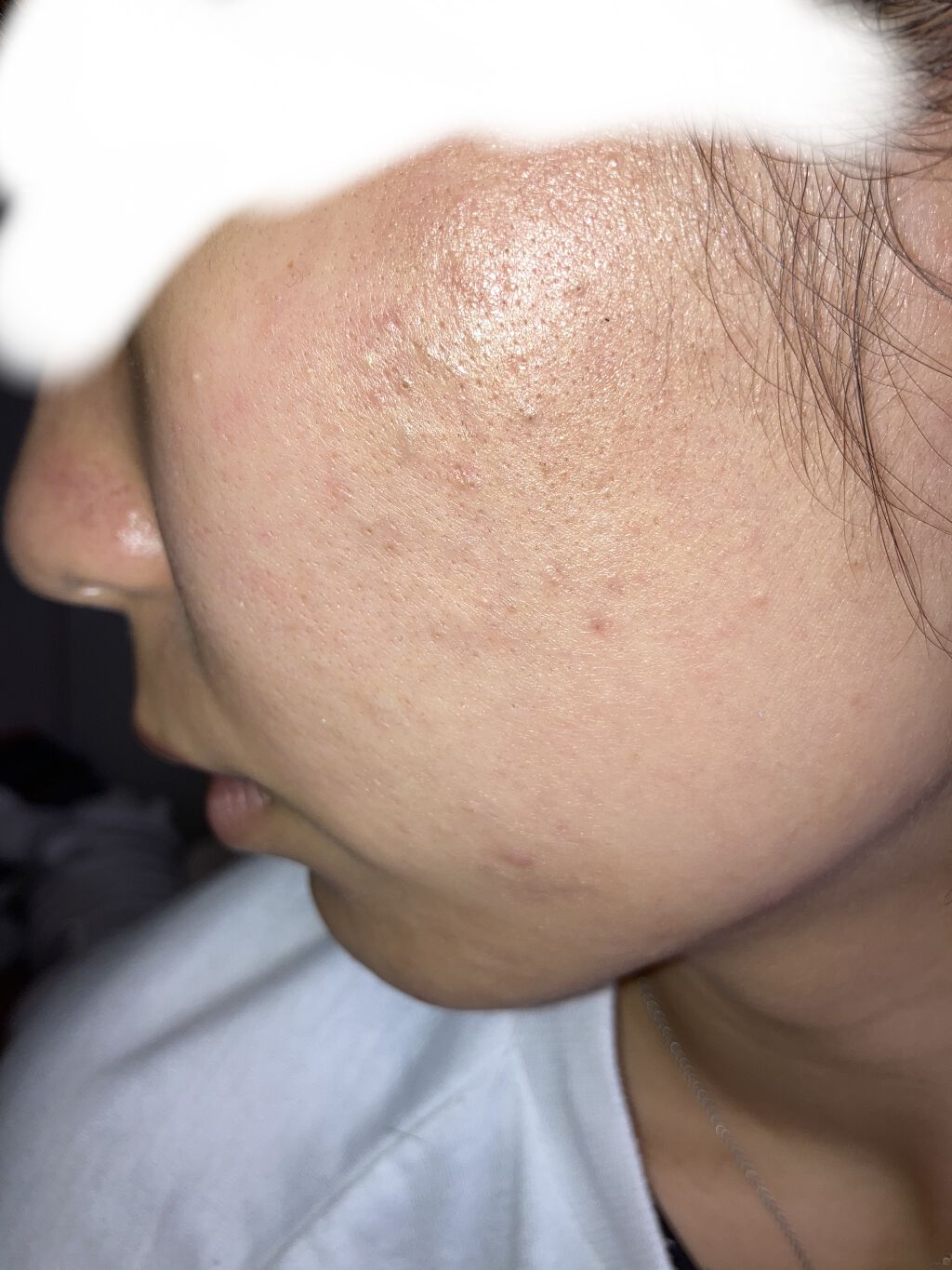 ペアアクネクリームW(医薬品)/ペア/その他を使ったクチコミ（1枚目）