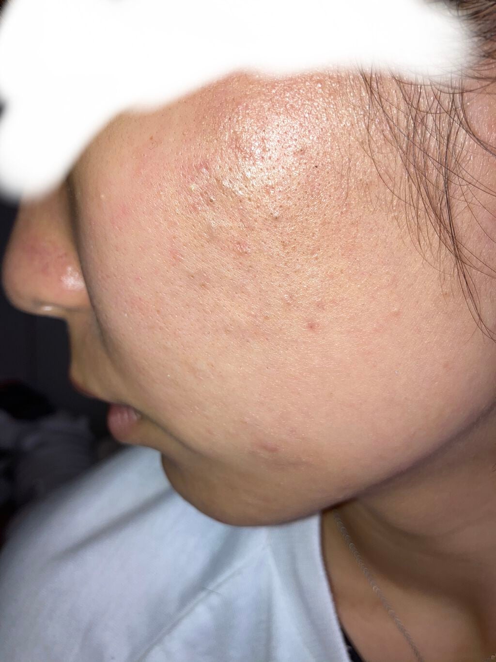 ペアアクネクリームW(医薬品)/ペア/その他を使ったクチコミ(1枚目)