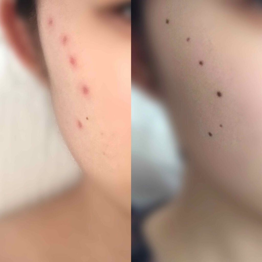 うい on LIPS 「ほくろ除去しました!!2枚目スライド注意です!2枚目の写真は右..」(2枚目)