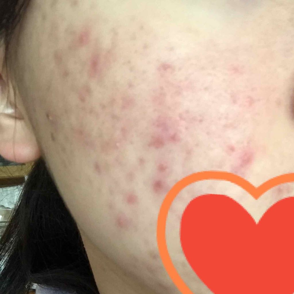 ペアアクネクリームW(医薬品)/ペア/その他を使ったクチコミ（2枚目）