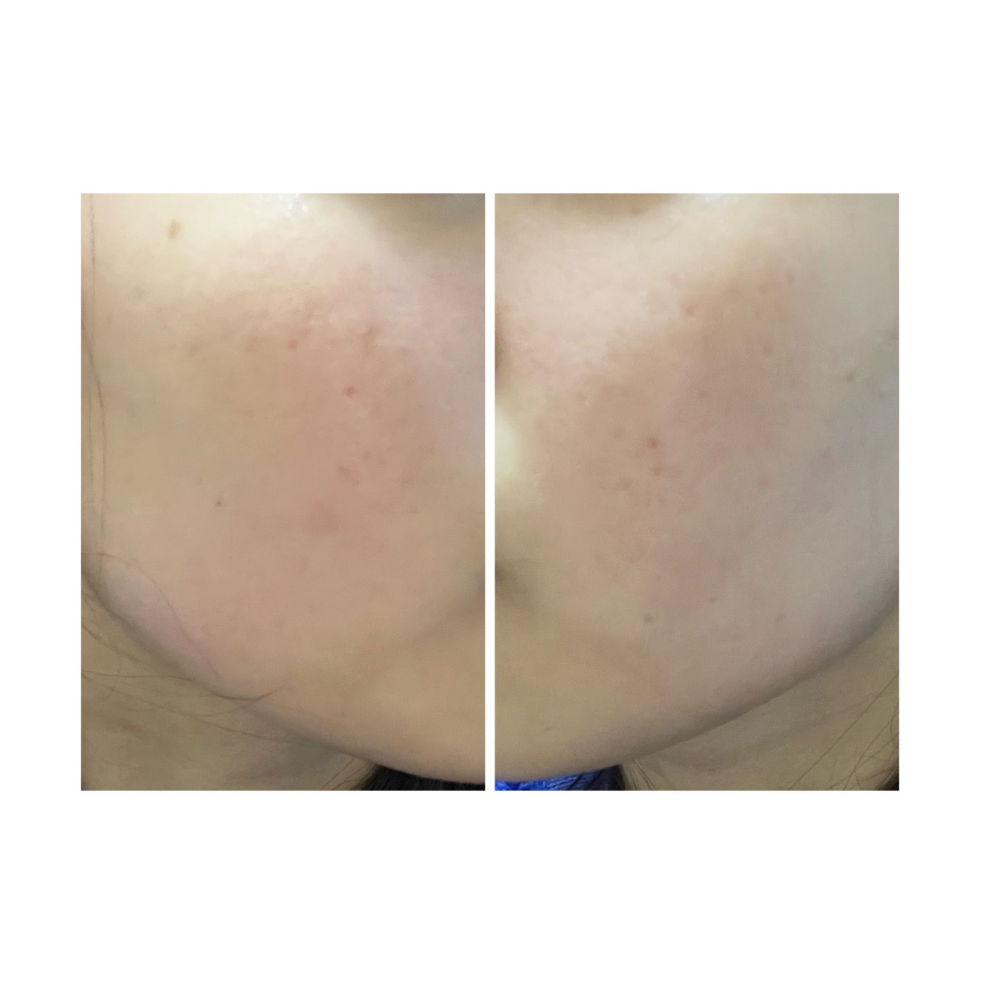 ぽむ on LIPS 「2023.9.13皮膚科に受診 エピデュオとヘパリン処方1枚目..」(5枚目)