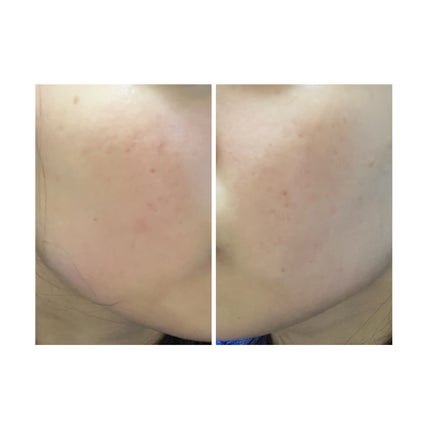 ぽむ on LIPS 「2023.9.13皮膚科に受診 エピデュオとヘパリン処方1枚目..」(5枚目)