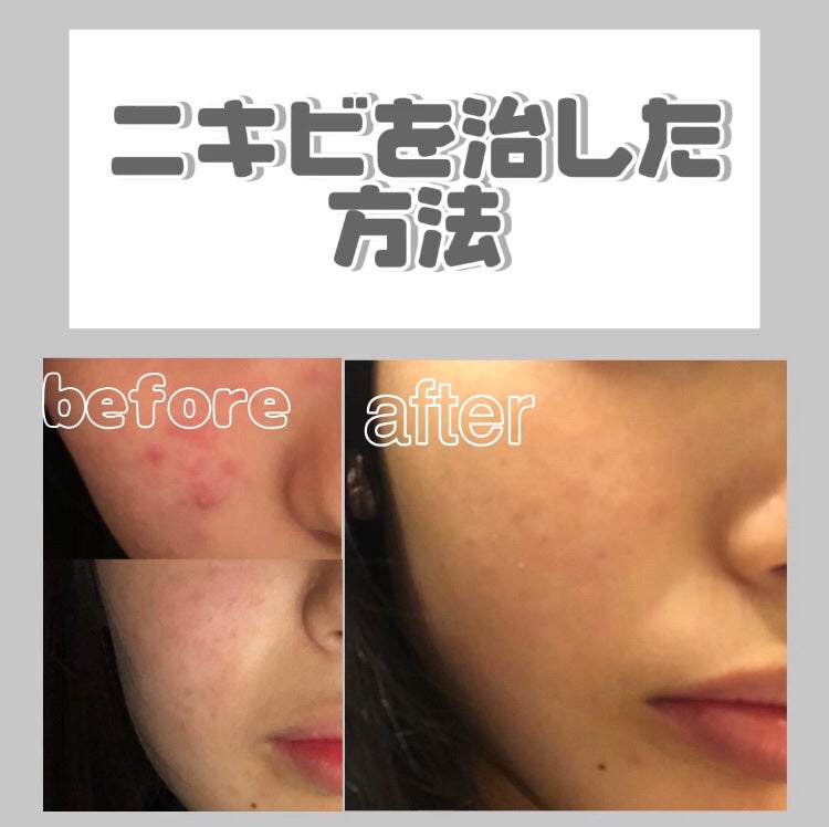 ペアアクネクリームW(医薬品)/ペア/その他を使ったクチコミ(1枚目)