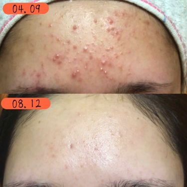 アベンヌ ウオーター アベンヌを使った口コミ ２枚目以降 閲覧注意 汚い肌お見せし By とろろこんぶ 代前半 Lips