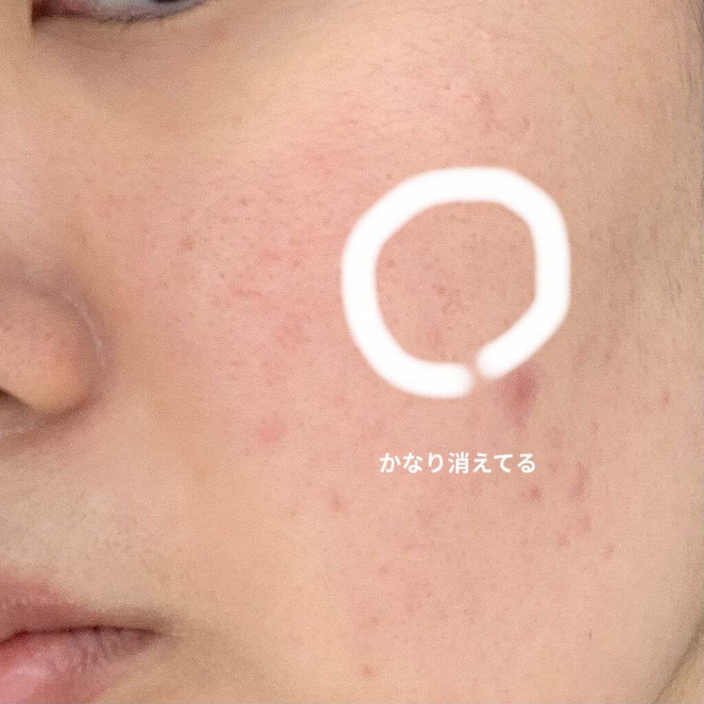 オロナインＨ軟膏 (医薬品)/オロナイン/その他を使ったクチコミ（3枚目）