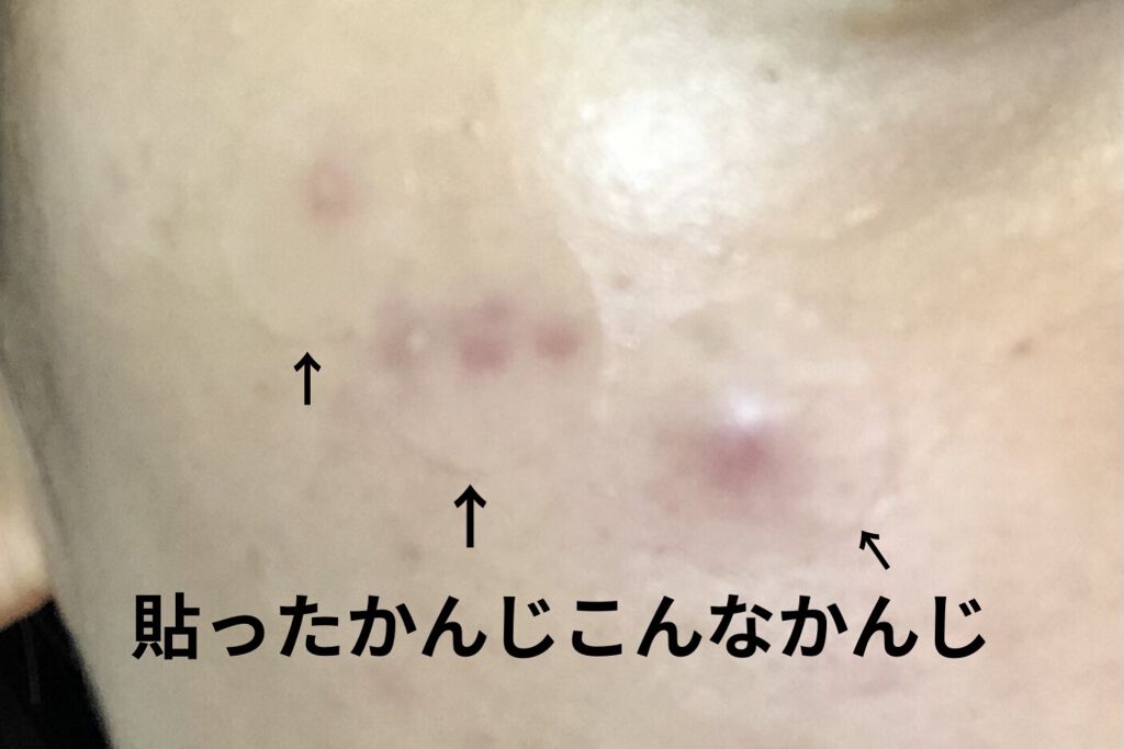 ポイントパッチ(集中ケアシート)/アクネスラボ/にきびパッチを使ったクチコミ（2枚目）